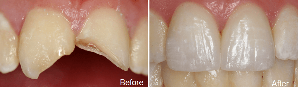 befor and after images of ceramic crowns treatment