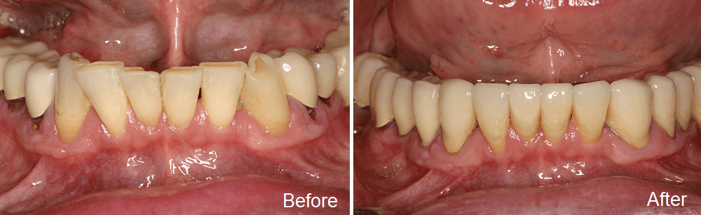 before and after images of lower teeth restored with new dental crowns
