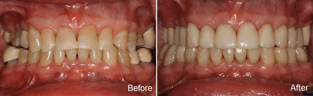 upper and lower teeth restored with dental crowns