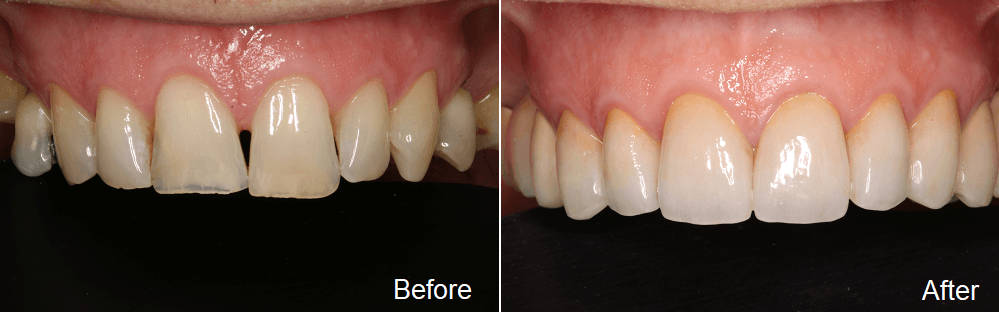 upper teeth restored with dental crowns