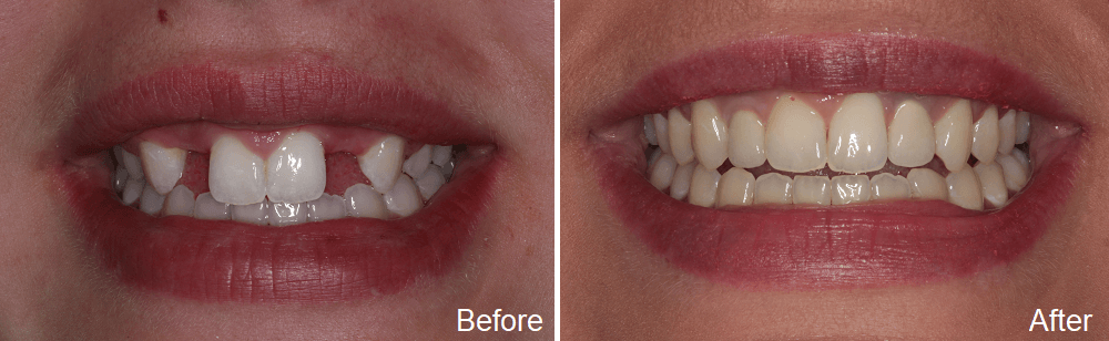 befor and after images of dental implant treatment
