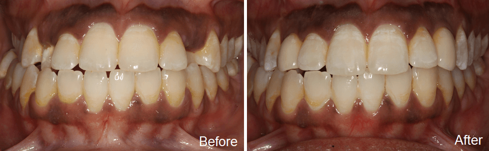 dental implant treatment near you