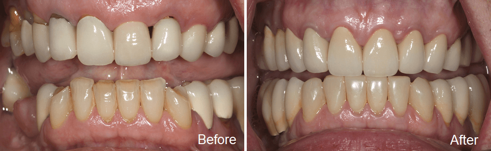 dental implants in millrise